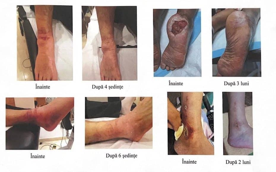 Terapia cu vacuum pentru piciorul diabetic